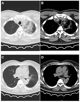 Frontiers | Case Report: A Chlamydia Psittaci Pulmonary Infection ...